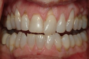 Before Gum Graft Photo: Exposed teeth roots