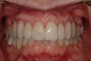 After Gum Grafting Surgery photo: Healed gums covering teeth roots