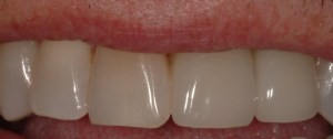 Photo of restored multiple upper teeth