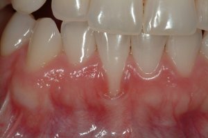 Photo of lower front teeth and gums before gum graft