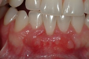 Photo of lower front teeth and gums after gum graft