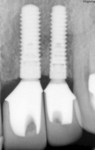 X-ray radiograph of multiple dental implants