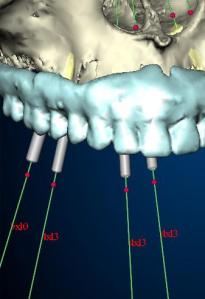 Illustration of Gentle Implant Placement
