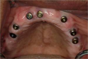 Photo of a patient's upper mouth with seven dental implant posts placed