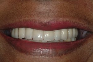 After photo of smiling woman with Gentle Implant Placement