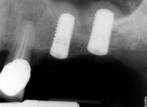 X-ray radiograph: After sinus lift, showing two dental implant posts in upper jaw