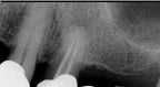 X-ray radiograph: Before Sinus Lift Missing upper teeth
