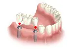 Illustration: Dental implant-supported dental bridge to replace missing back teeth