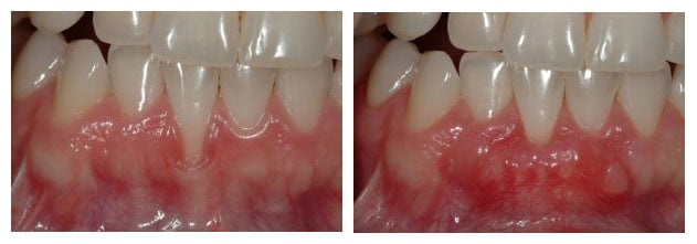 Before and After photos of a Gum Graft to cover an exposed tooth root in the lower jaw