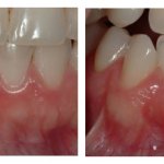 Before and After photos of a Gum Graft to cover an exposed tooth root in the lower jaw