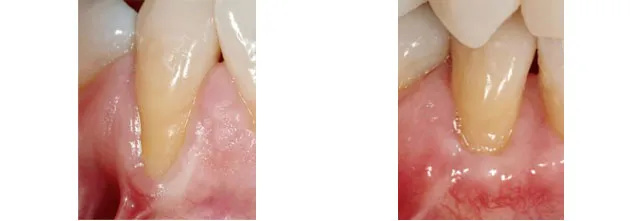 Before and After photos of a Gum Graft to cover an exposed lower tooth’s root