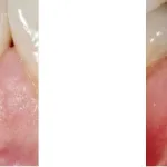 Before and After photos of a Gum Graft to cover an exposed lower tooth’s root