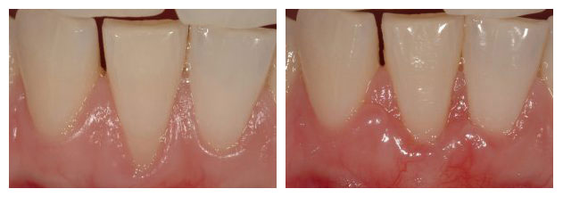 Before and After photos of a Gum Graft to cover an exposed and sensitive lower tooth root