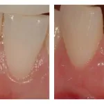 Before and After photos of a Gum Graft to cover an exposed and sensitive lower tooth root