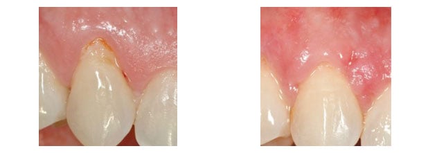 Before and After photos of a gum graft to cover exposed upper tooth roots