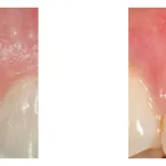 Before and After photos of a gum graft to cover exposed upper tooth roots