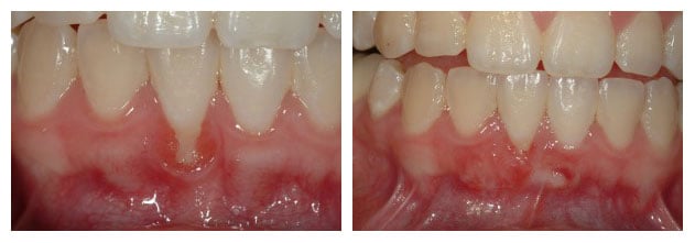 Before and After photos of a gingival graft to cover a lower tooth's root