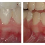 Before and After photos of a gingival graft to cover a lower tooth's root