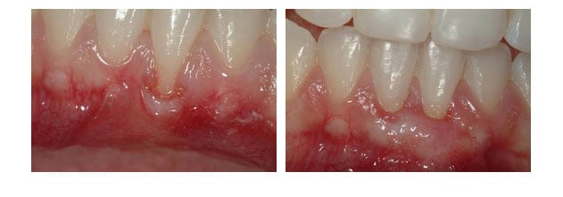 Before and After photos of a gum graft to cover a lower tooth's root