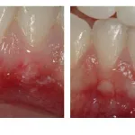 Before and After photos of a gum graft to cover a lower tooth's root