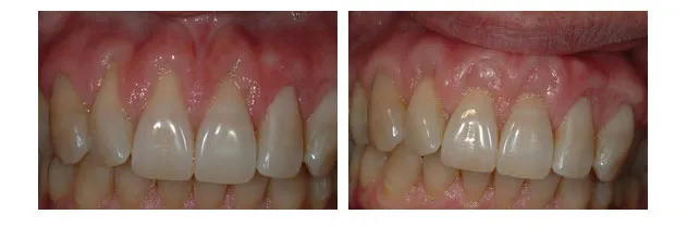 Before and After photos of a gum graft to cover exposed roots of two front upper teeth