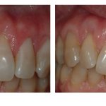 Before and After photos of a gum graft to cover exposed roots of two front upper teeth