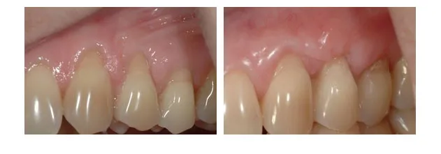 Before and After photos of a gingival graft to cover exposed roots of several upper side teeth