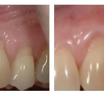 Before and After photos of a gingival graft to cover exposed roots of several upper side teeth