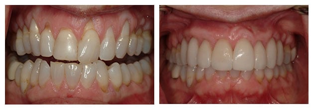 Before and After photos of a gingival grafts for both upper and lower teeth