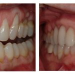 Before and After photos of a gingival grafts for both upper and lower teeth