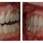 Before and After photos of a gingival grafts for both upper and lower teeth