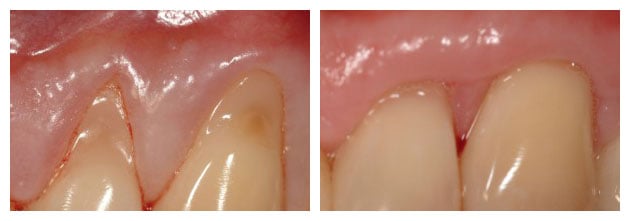 Before and After photos of Gingival grafting to cover exposed roots of teeth