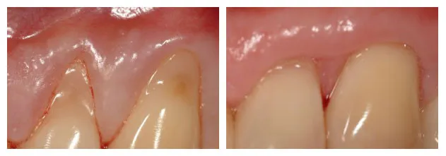 Before and After photos of Gingival grafting to cover exposed roots of teeth