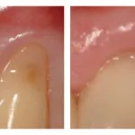 Before and After photos of Gingival grafting to cover exposed roots of teeth