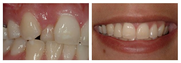 Before and After photos of poorly positioned upper incisor tooth and correctly aligned dental implant replacement
