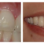 Before and After photos of poorly positioned upper incisor tooth and correctly aligned dental implant replacement