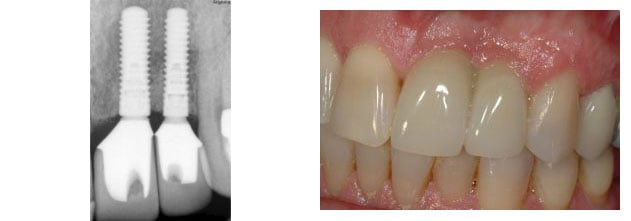 Before and After photos of Dental Implants to replace upper central and lateral incisor