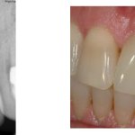 Before and After photos of Dental Implants to replace upper central and lateral incisor