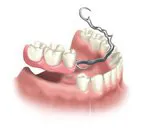 Illustration: Removable partial denture to replace missing back teeth