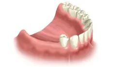 Illustration of missing lower back teeth