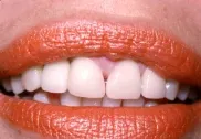 Photo of woman smiling with a Single Dental Implant Tooth