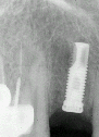 X-ray radiograph: Single Tooth Dental Implant Post