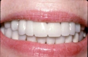 Photo of a fixed bridge supported by dental implants