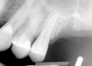 X-ray radiograph: Jaw bone before sinus lift