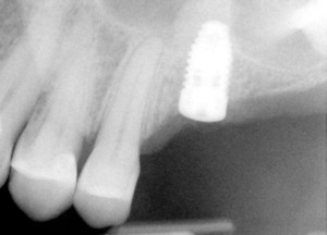 X-ray radiograph: Jaw bone after sinus lift with dental implant