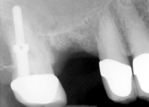 X-ray radiograph: Before sinus lift and dental implant