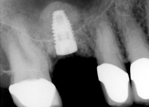 X-ray radiograph: After photo of dental implant after sinus lift