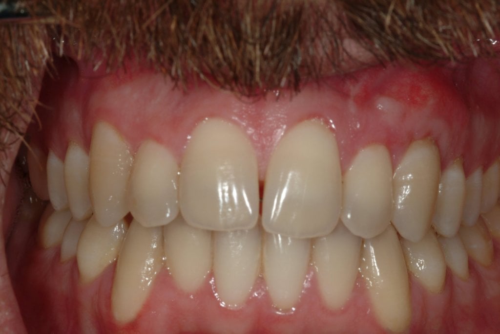 After photo: Upper and lower gum recessions corrected with gingival grafts