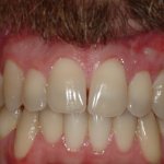 After photo: Upper and lower gum recessions corrected with gingival grafts