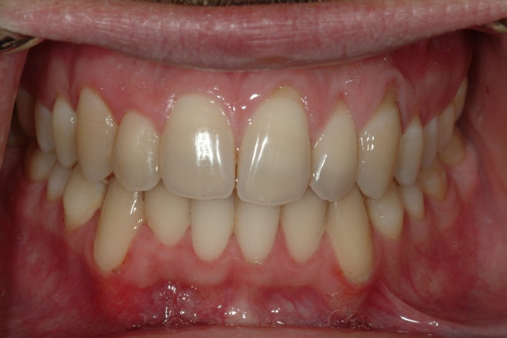 Before photo: Gum recession and exposed tooth roots in upper and lower jaws